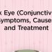 Useful tips for protecting your eyes from conjunctivitis